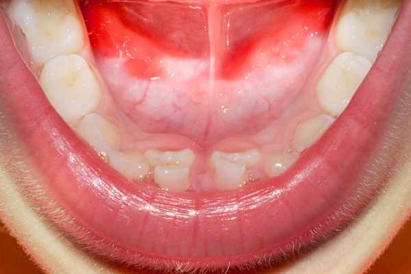 Considering Orthodontic Treatment Part 4: Pulling Permanent Teeth