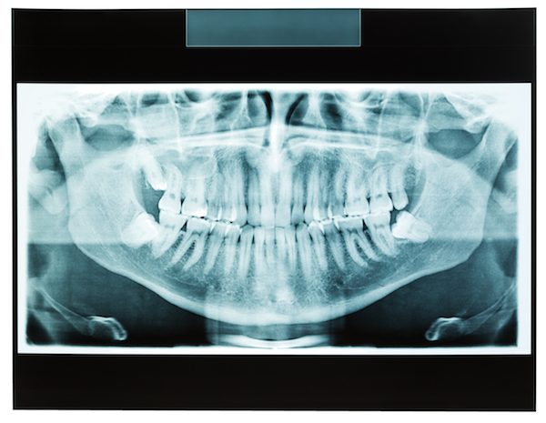 Considering Orthodontic Treatment Part 3: Correcting Your Bite
