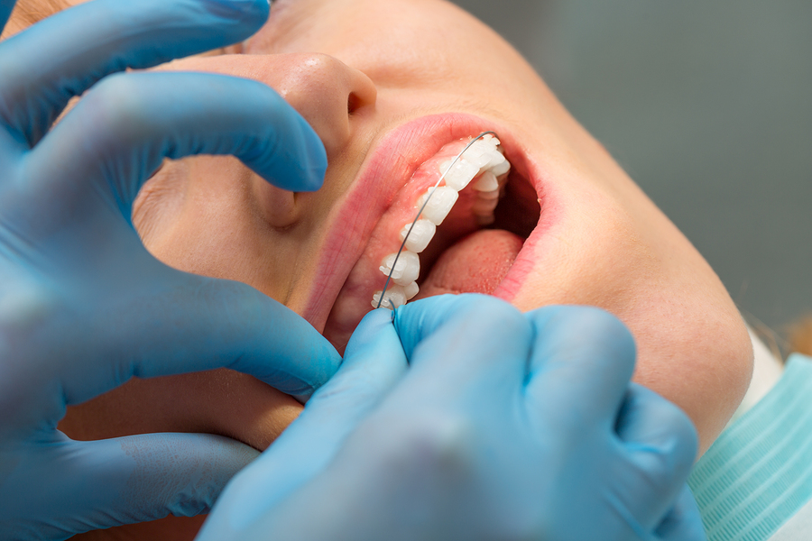 Cutting Down Time in Braces: Accelerating Orthodontic Treatment