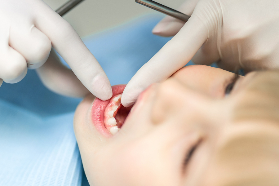 Removing Baby Teeth vs. Permanent Teeth